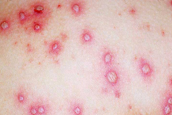 Hình ảnh bệnh thủy đậu ở trẻ em xuất hiện biến chứng nhiễm trùng da